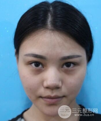 在漢中韓美做了隆鼻整形一個(gè)月，恢復(fù)越來越自然了