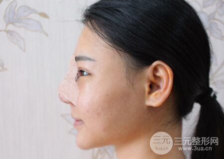 在漢中韓美做了隆鼻整形一個(gè)月，恢復(fù)越來越自然了