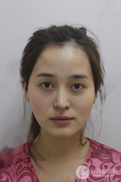 自體脂肪面部填充后成活率超高，少女感十足