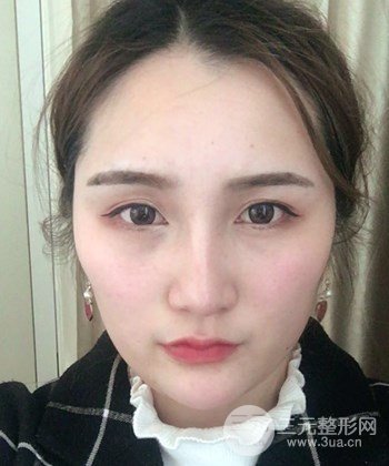 面部埋埋蛋白線(xiàn).提升前后對(duì)比照片,皮膚緊致了不少