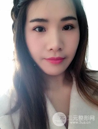 漢中韓美切開雙眼皮開眼角恢復(fù)對比照片