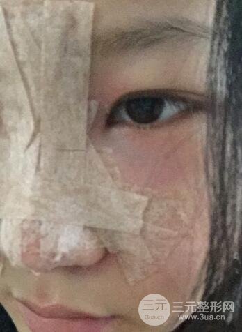 長沙鵬愛隆鼻整形果展示 恢復過程圖