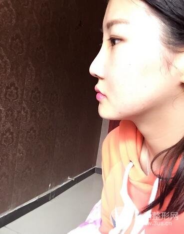 長沙鵬愛隆鼻整形果展示 恢復過程圖