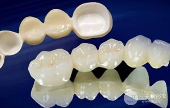 烤瓷牙的種類有哪些、烤瓷牙價格多少