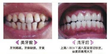 烤瓷牙價(jià)格和種類(lèi)有哪些|烤瓷牙果對(duì)比圖