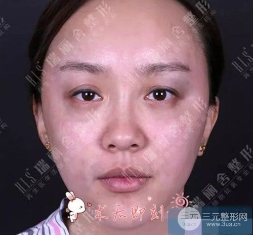 臉頰凹陷部位做完脂肪填充果