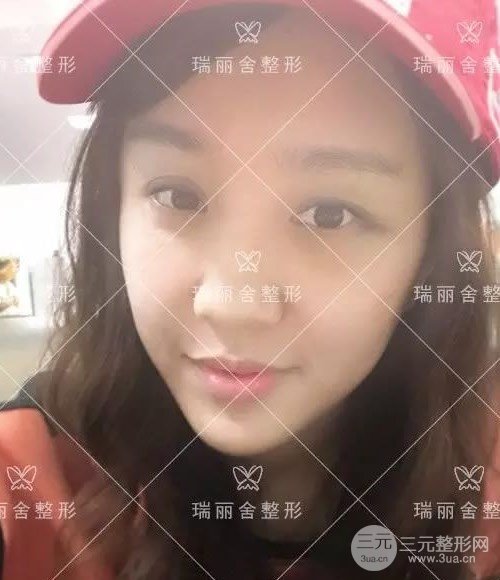 面部填充手術(shù)第4天