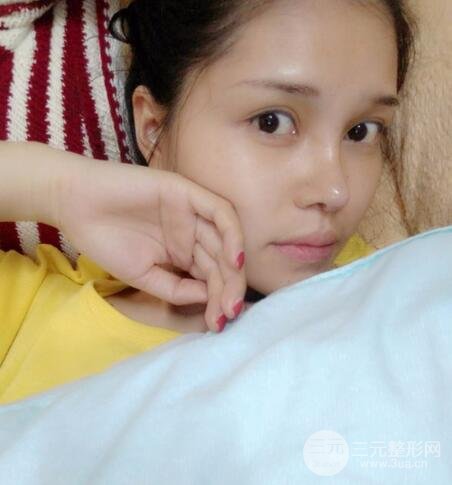 鼻頭縮小術(shù)過程圖,鼻頭縮小恢復(fù)日記