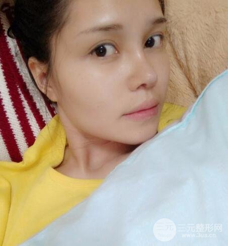 鼻頭縮小術(shù)過程圖,鼻頭縮小恢復(fù)日記