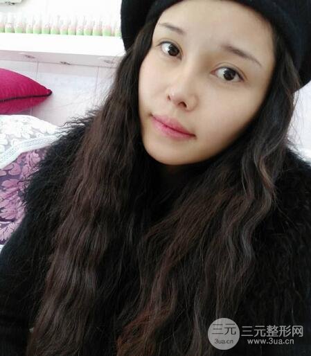 鼻頭縮小術(shù)過程圖,鼻頭縮小恢復(fù)日記