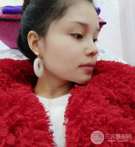 鼻頭縮小術(shù)過程圖,鼻頭縮小恢復(fù)日記