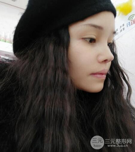 鼻頭縮小術(shù)過程圖,鼻頭縮小恢復(fù)日記