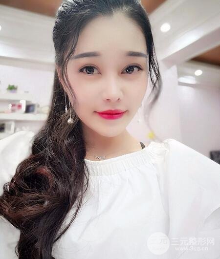 鼻頭縮小術(shù)過程圖,鼻頭縮小恢復(fù)日記