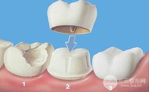 做美容冠用什么材料、美容冠多少錢一顆