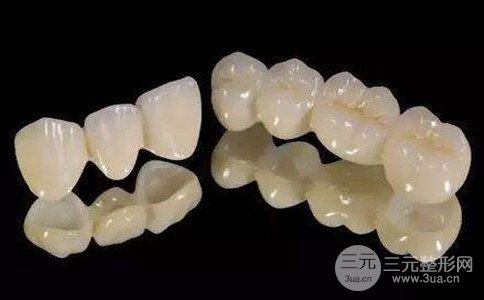 烤瓷牙有哪些種類、烤瓷牙多少錢一顆