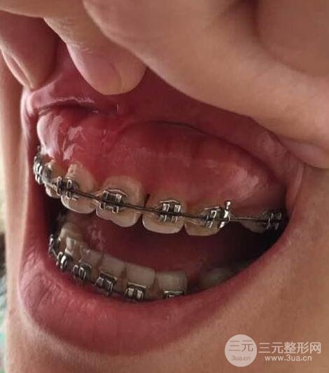 骨性齙牙要怎么矯正？