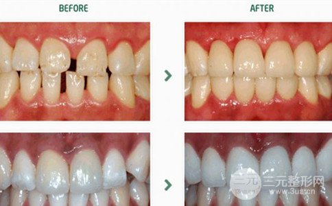 鎳鉻烤瓷牙可以用嗎、鎳鉻烤瓷牙多少錢(qián)