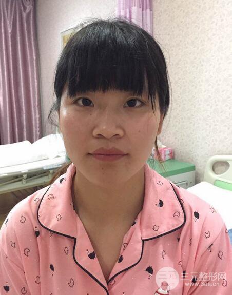 隆鼻鼻翼縮小全過程和術(shù)后照片分享,隨意揉捏很OK