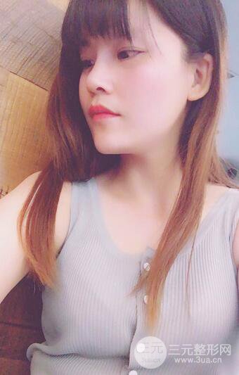 隆鼻鼻翼縮小全過程和術(shù)后照片分享,隨意揉捏很OK