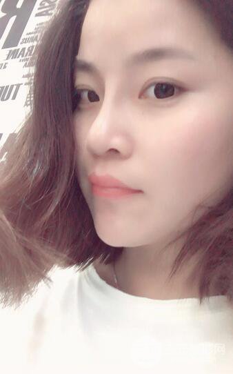 隆鼻鼻翼縮小全過程和術(shù)后照片分享,隨意揉捏很OK