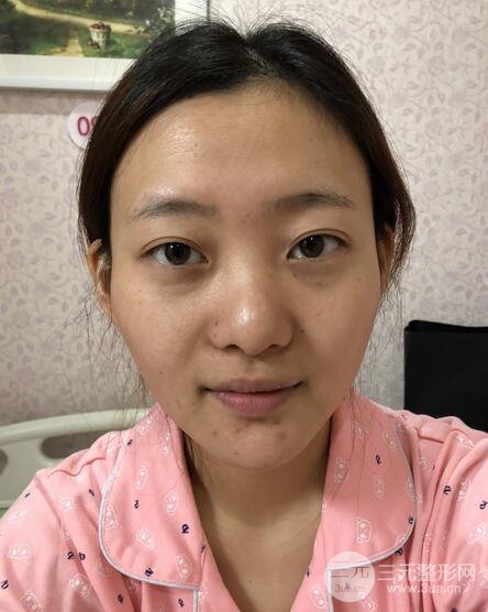 肋軟骨隆鼻+歪鼻矯正案例