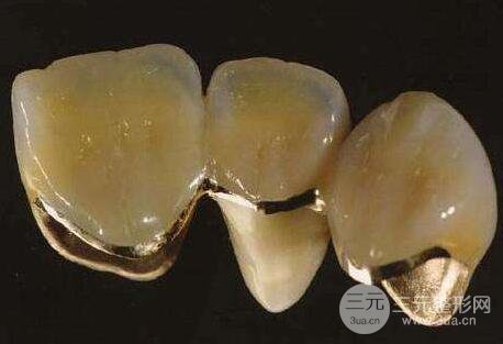 貴金屬烤瓷牙