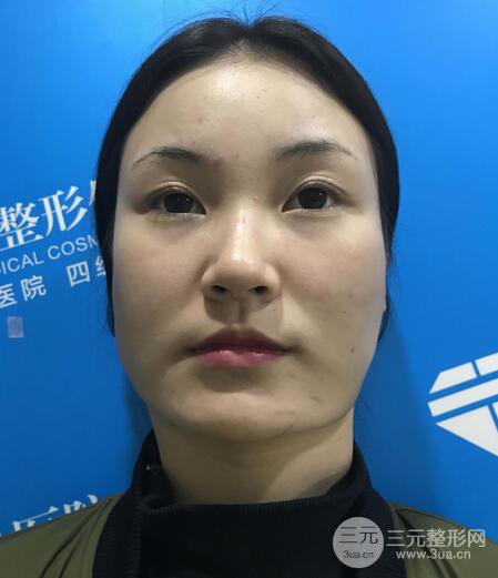 下頜角磨骨整形全過程分享,附上術后恢復照片~