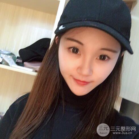 下頜角磨骨整形全過程分享,附上術后恢復照片~