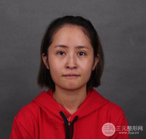 硅膠隆鼻術(shù)前術(shù)后對(duì)比照片分享,走上顏值頂峰