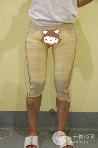 大腿抽脂果好到不行、瘦十厘米不是問題