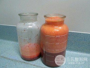 大腿抽脂果好到不行、瘦十厘米不是問題