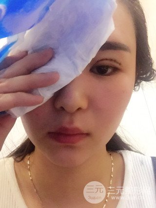 深圳全切雙眼皮修復(fù)成功案例恢復(fù)過程分享