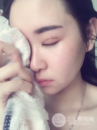 深圳全切雙眼皮修復(fù)成功案例恢復(fù)過程分享