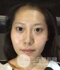 顴骨磨骨改臉型過(guò)程和恢復(fù)步驟照片(圖)