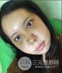 顴骨磨骨改臉型過(guò)程和恢復(fù)步驟照片(圖)