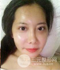 顴骨磨骨改臉型過(guò)程和恢復(fù)步驟照片(圖)