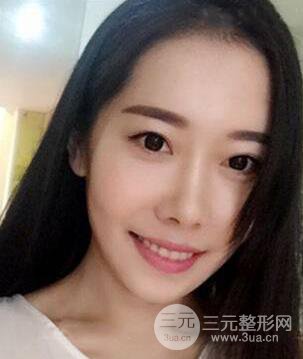 顴骨磨骨改臉型過(guò)程和恢復(fù)步驟照片(圖)