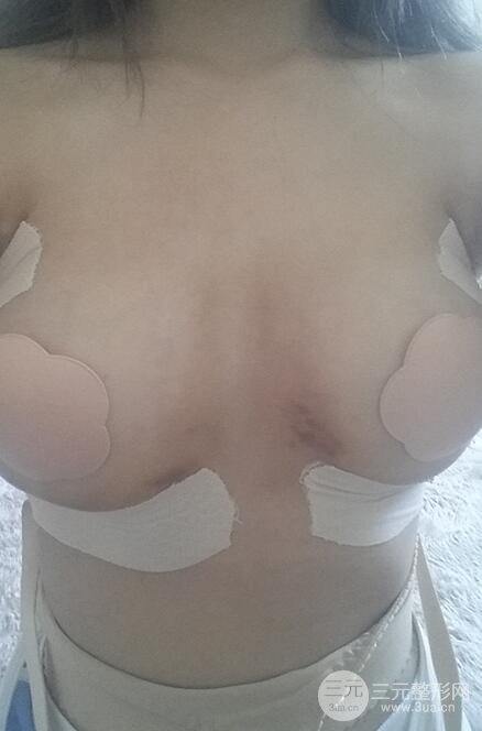 廣東省第二人民醫(yī)院羅盛康假體隆胸前后對比案例