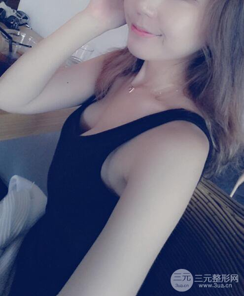 廣東省第二人民醫(yī)院羅盛康假體隆胸前后對比案例