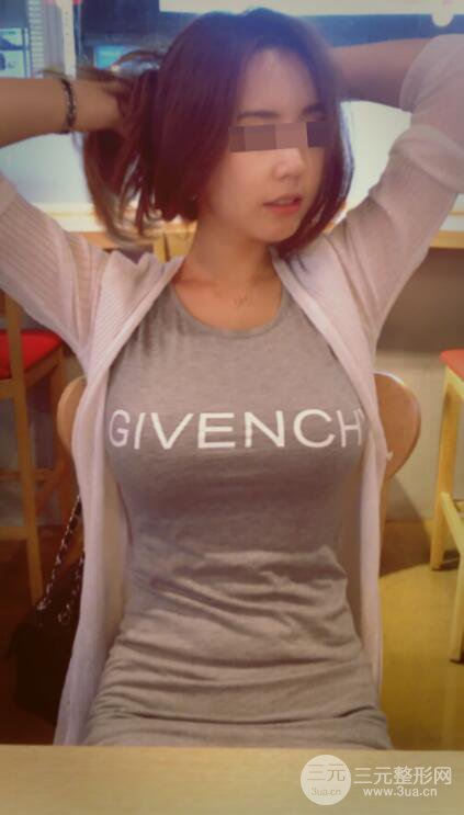 廣東省第二人民醫(yī)院羅盛康假體隆胸前后對比案例