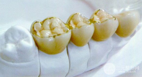 黃金烤瓷牙價(jià)格、大概多少錢一顆