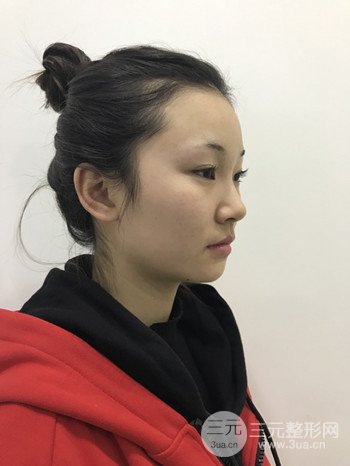 濟(jì)南硅膠假體墊下巴真人案例、下巴改變整個(gè)臉型