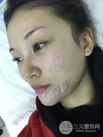 濟(jì)南硅膠假體墊下巴真人案例、下巴改變整個(gè)臉型