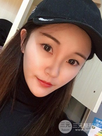 濟(jì)南硅膠假體墊下巴真人案例、下巴改變整個(gè)臉型