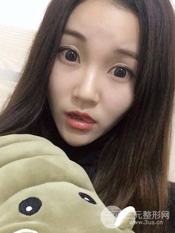 濟(jì)南硅膠假體墊下巴真人案例、下巴改變整個(gè)臉型