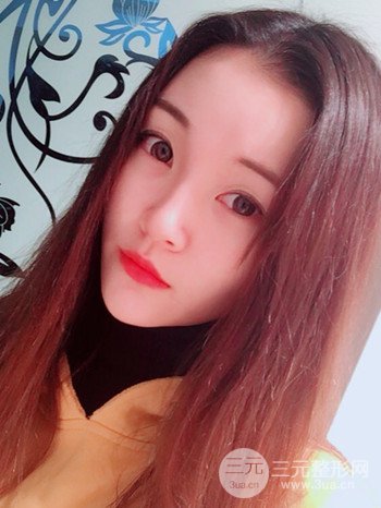 濟(jì)南硅膠假體墊下巴真人案例、下巴改變整個(gè)臉型