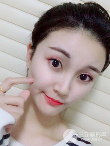 濟(jì)南硅膠假體墊下巴真人案例、下巴改變整個(gè)臉型