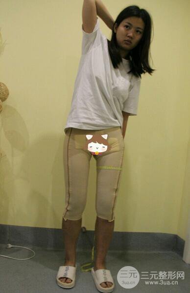 大腿吸脂后恢復(fù)過程及術(shù)后照片分享【圖片】