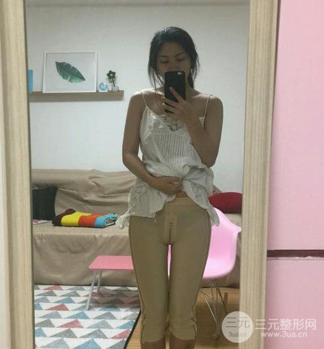 大腿吸脂后恢復(fù)過程及術(shù)后照片分享【圖片】