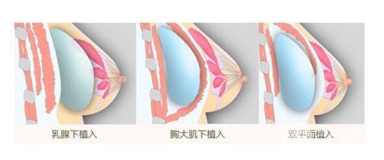 雙平面豐胸果怎么樣、雙平面假體豐胸多少錢